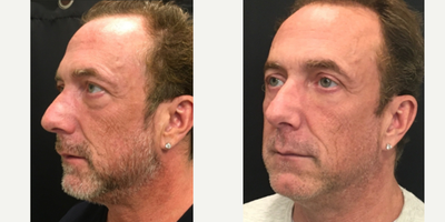Dermal Fillers before and after photo