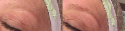 Facial before and after photo