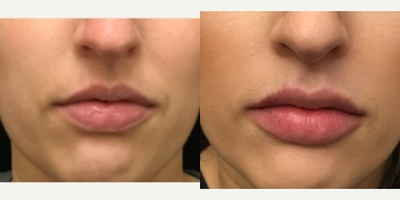 Juvederm before and after photo