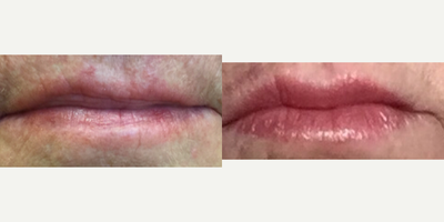 Juvederm before and after photo