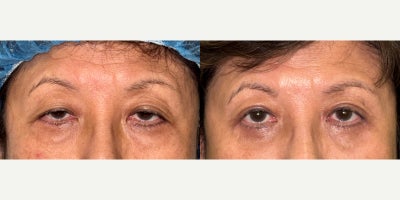 Ptosis Surgery before and after photo