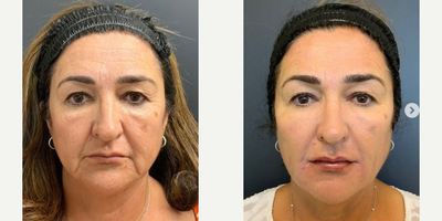 Radiesse before and after photo