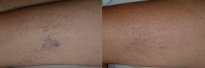 Sclerotherapy before and after photo