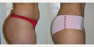 Abdominal Etching before and after photo