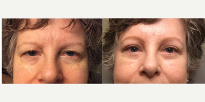 Brow Lift before and after photo