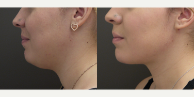 Chin Liposuction before and after photo
