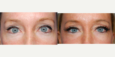 CO2 Laser before and after photo