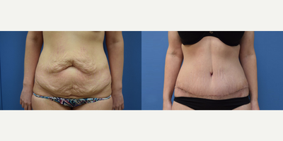 Tummy Tuck before and after photo