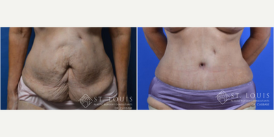 Tummy Tuck before and after photo