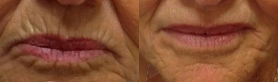 Dermal Fillers before and after photo