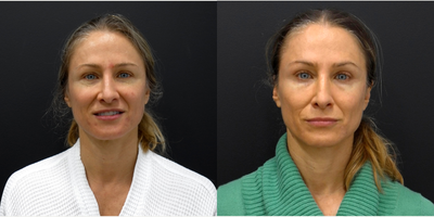 Eyelid Surgery before and after photo