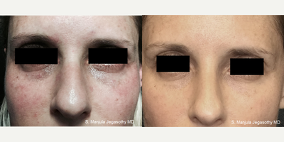 Fraxel Laser before and after photo