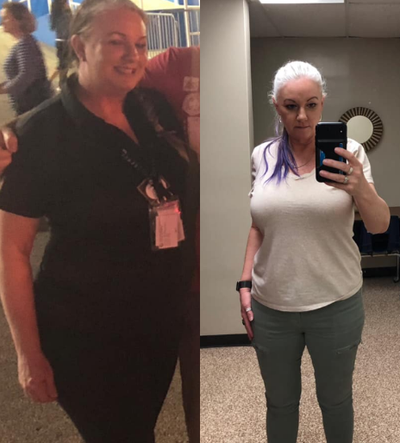 Gastric Sleeve Surgery before and after photo