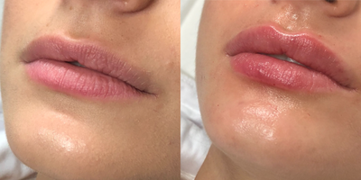 Lip Fillers before and after photo