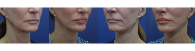 Lip Fillers before and after photo