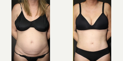 Mini Tummy Tuck before and after photo