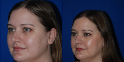 Septoplasty before and after photo