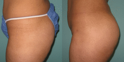 Brazilian Butt Lift before and after photo