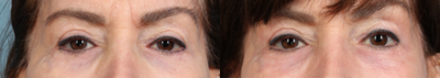 CO2 Laser before and after photo
