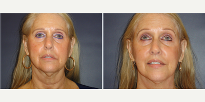 Facelift before and after photo