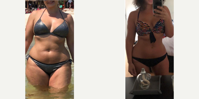Gastric Balloon before and after photo