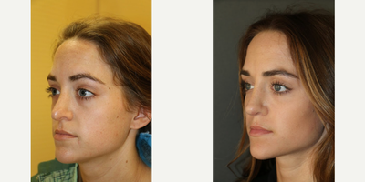 Revision Rhinoplasty before and after photo