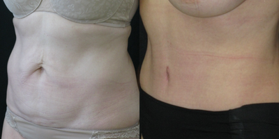 Breast Lift before and after photo