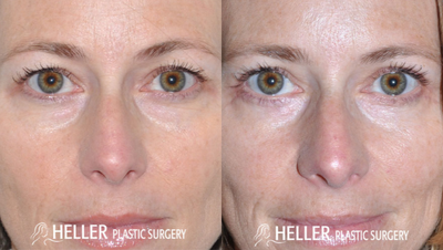 Eyelid Surgery before and after photo