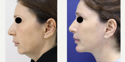 Facelift before and after photo