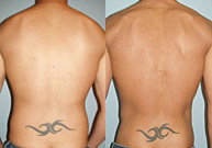Liposuction before and after photo