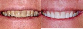 Teeth Whitening before and after photo