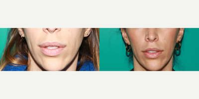 Lip Lift before and after photo