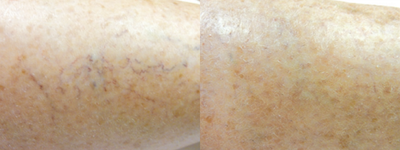 Sclerotherapy before and after photo