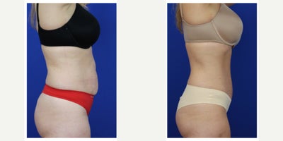 Tummy Tuck before and after photo