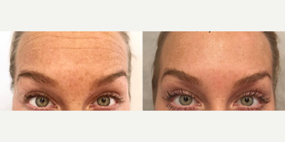 Xeomin before and after photo
