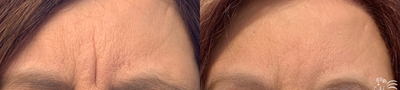 Dysport before and after photo