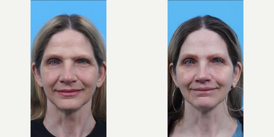 Eyelid Surgery before and after photo
