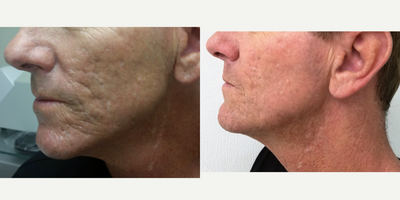 Halo Laser before and after photo