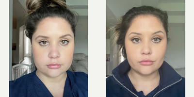 Buccal Fat Removal before and after photo