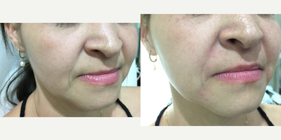 Dermal Fillers before and after photo