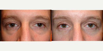 Eyelid Surgery before and after photo