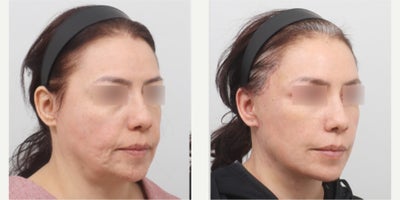 Eyelid Surgery before and after photo