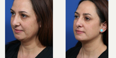 Kybella before and after photo