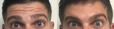 Botox before and after photo