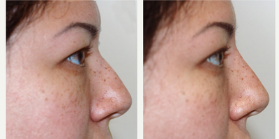 Restylane Silk before and after photo