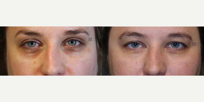 Botox before and after photo