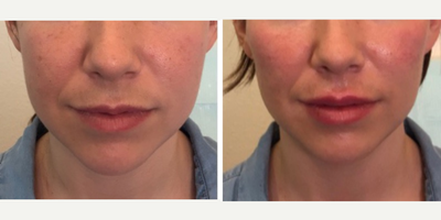 Dermal Fillers before and after photo