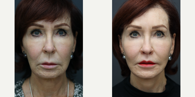 Facelift before and after photo