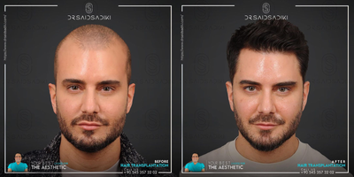 Hair Transplant before and after photo
