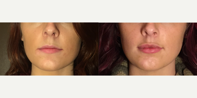 Juvederm before and after photo